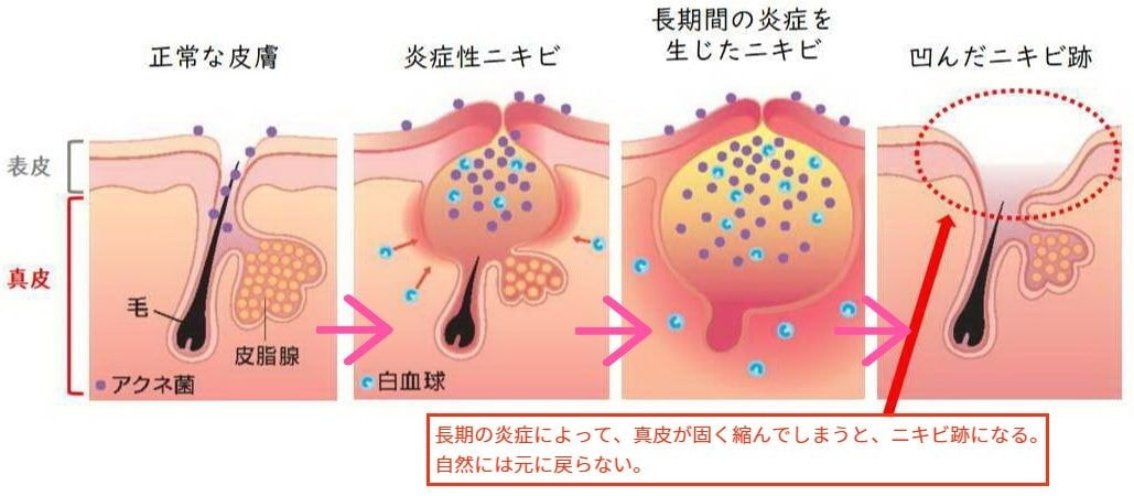 ニキビ跡とは