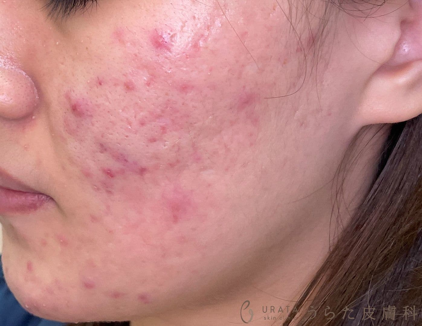 ニキビのホルモン治療 治療前