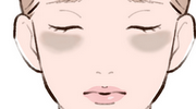 肝斑のイラスト