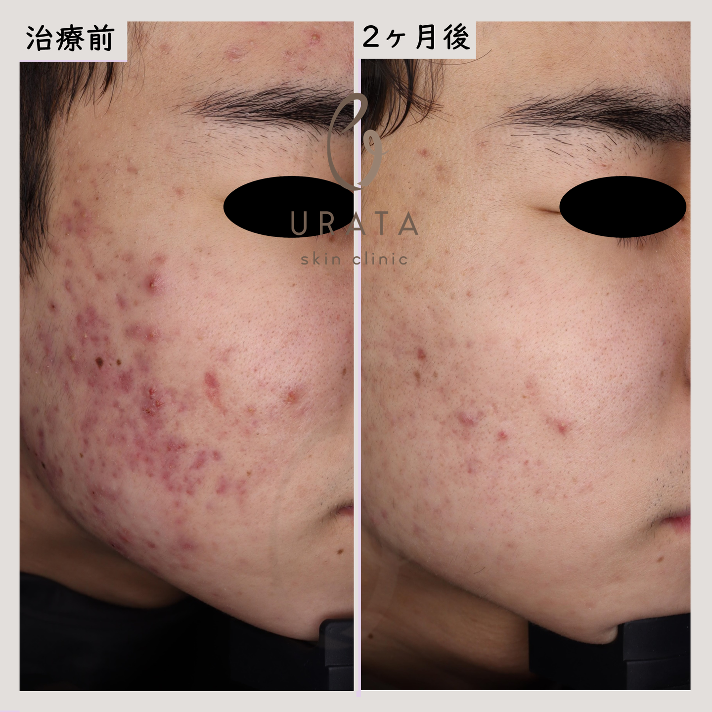 Vビームの赤いニキビとニキビ跡治療