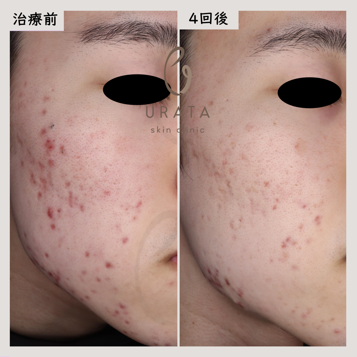 Vビームの赤いニキビ跡治療