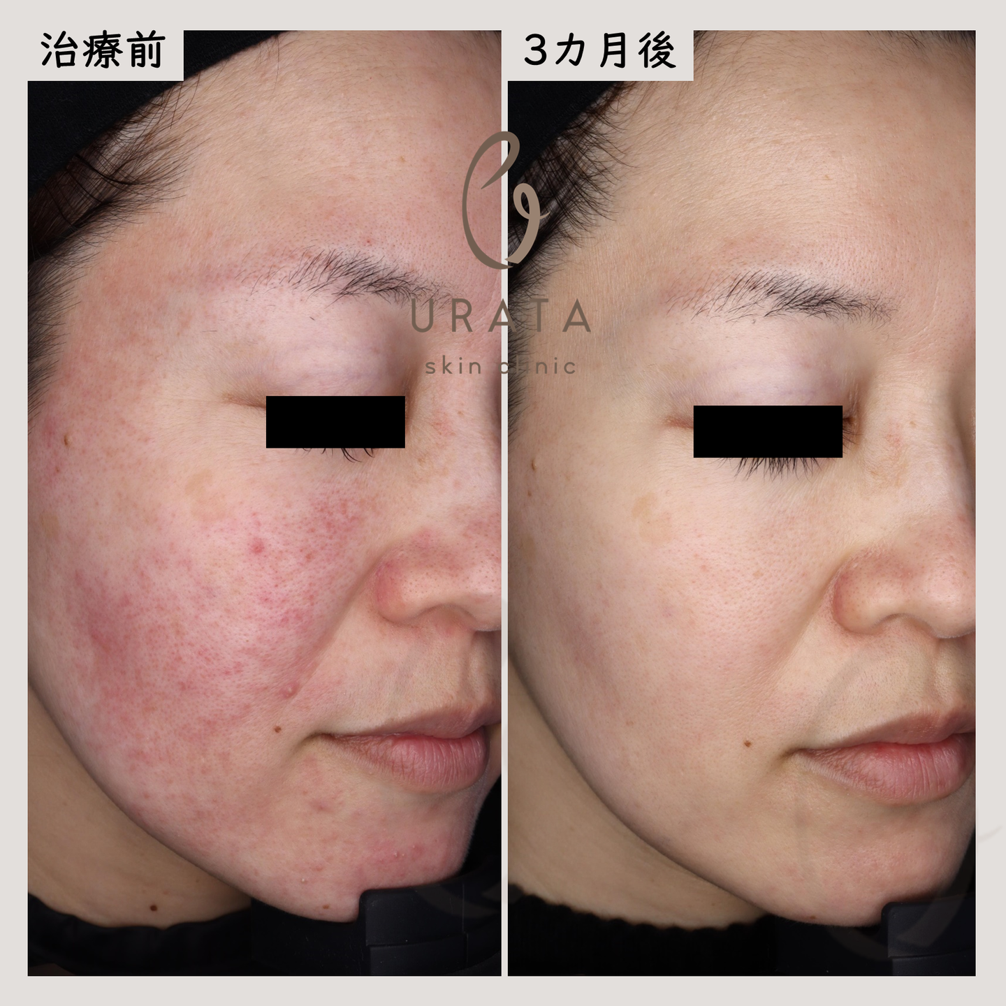 酒さの症例写真2