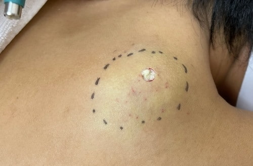 背部粉瘤のくりぬき法