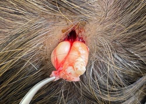 頭部の粉瘤摘出