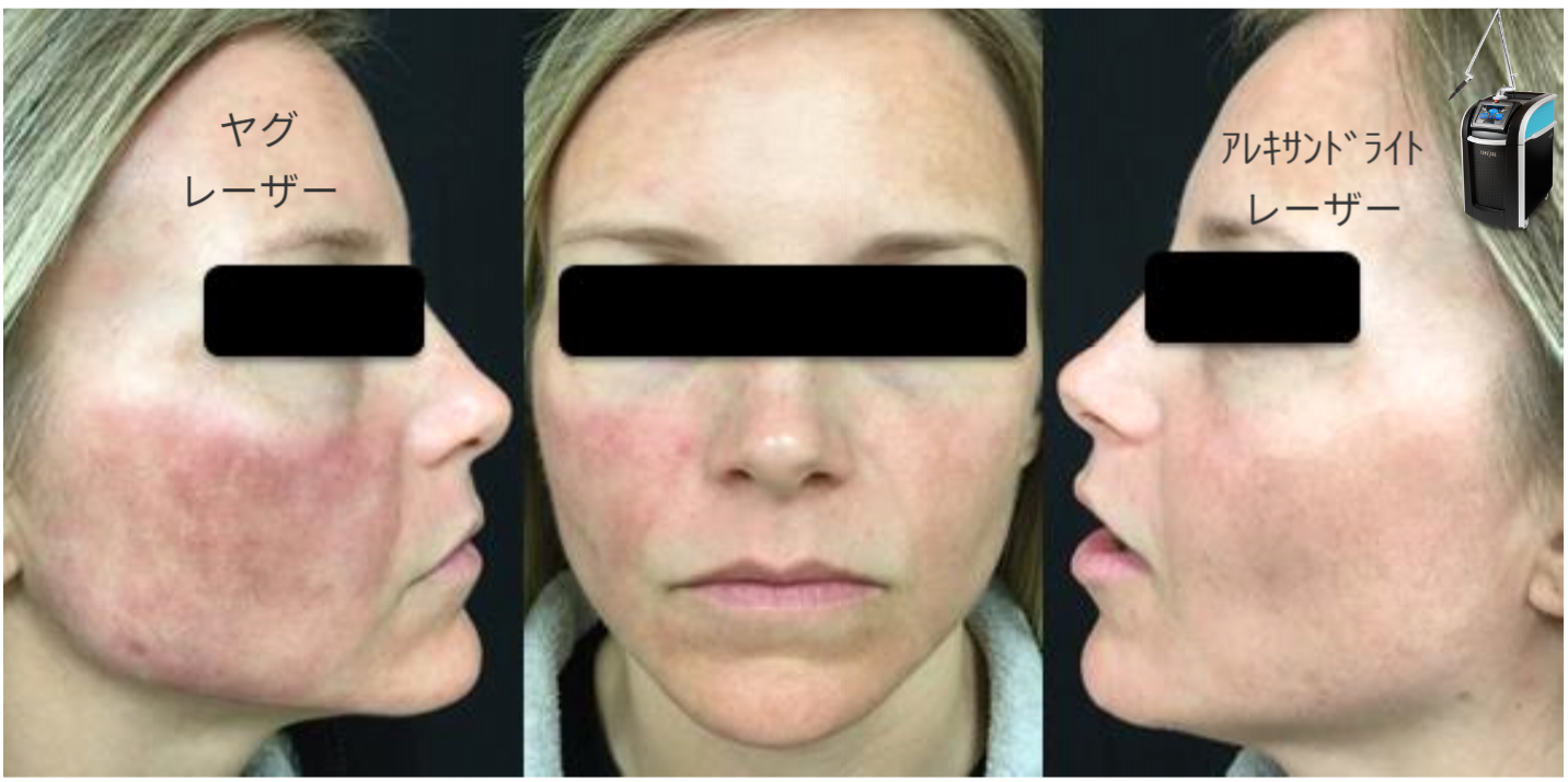 ピコアレキサンドライトレーザーとピコヤグレーザーの差