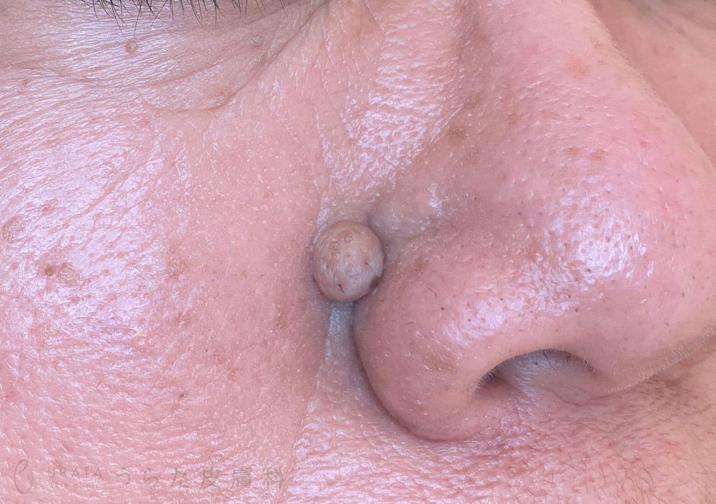 鼻のほくろ 手術前