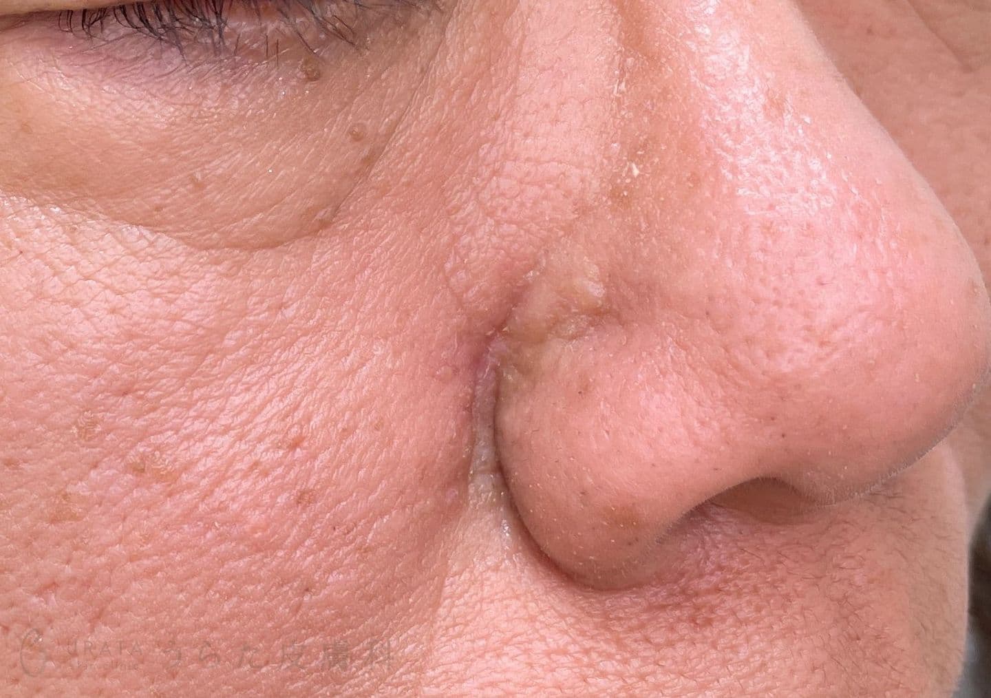 鼻のほくろ 手術前1カ月後