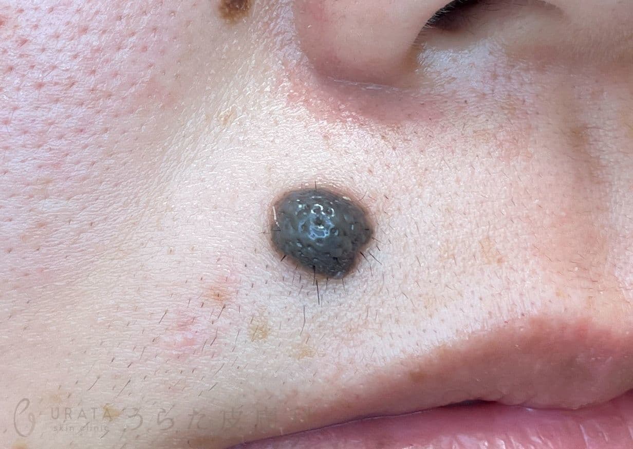 鼻下のほくろ 手術前