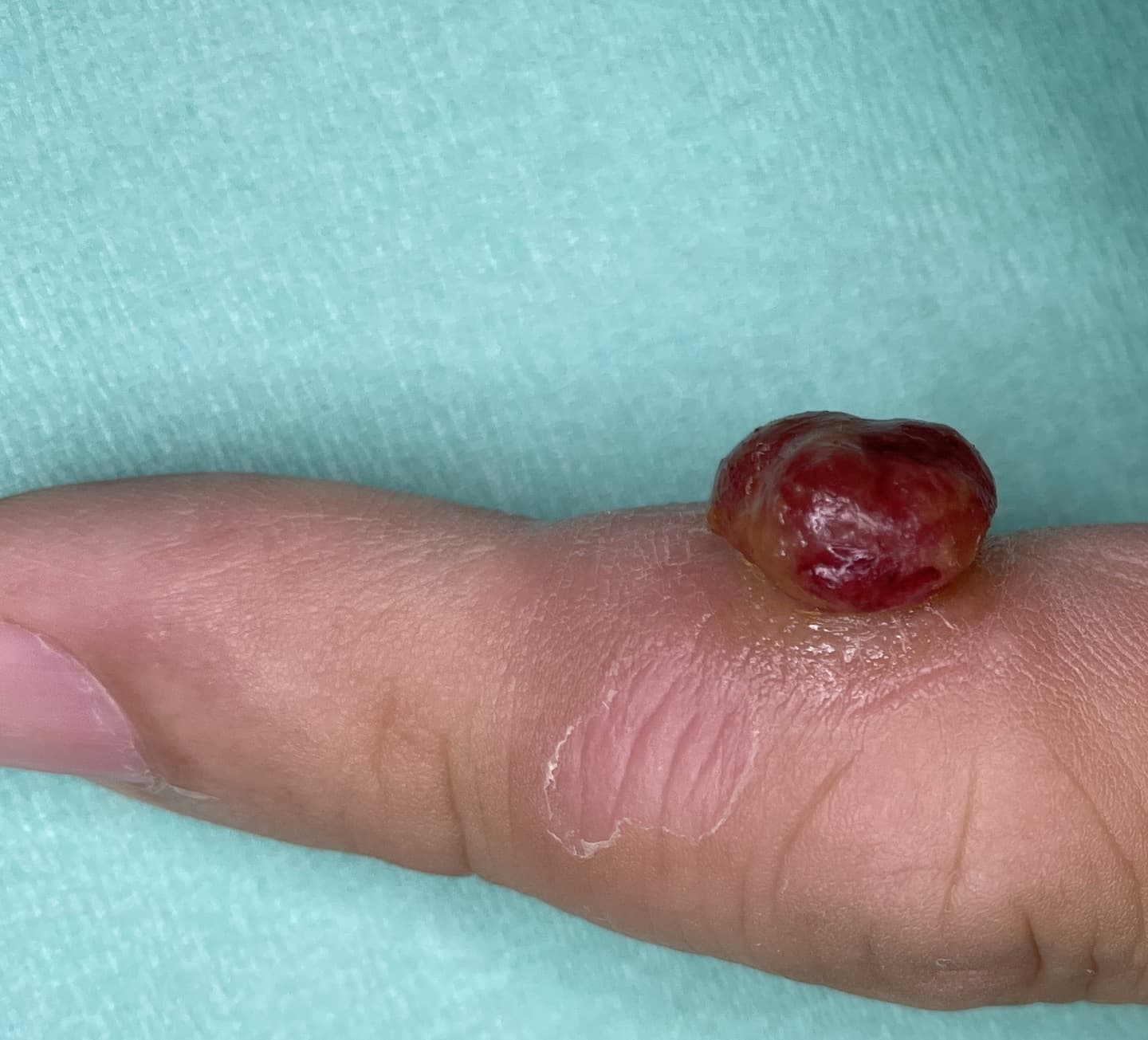 化膿性肉芽腫