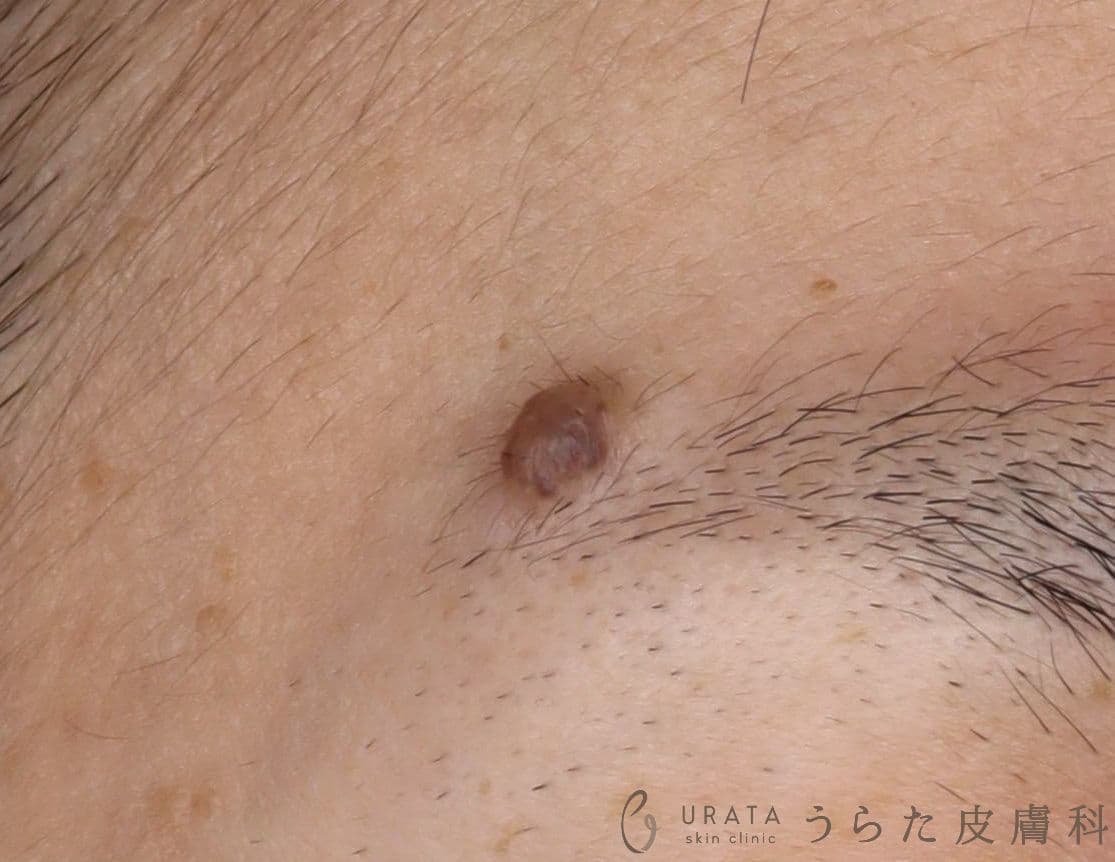 眉部のほくろ 術前