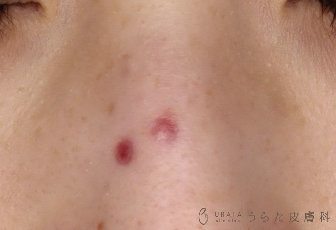 ホクロくり抜き法 術後1週