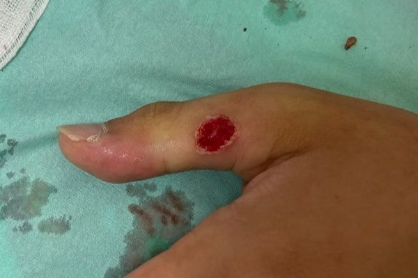 イボ手術直後