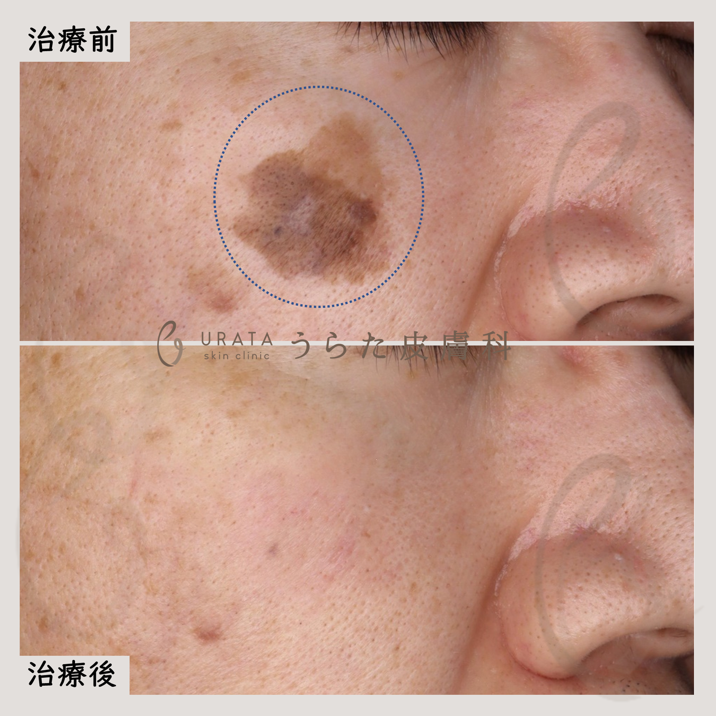 脂漏性角化症のCO2レーザー治療1