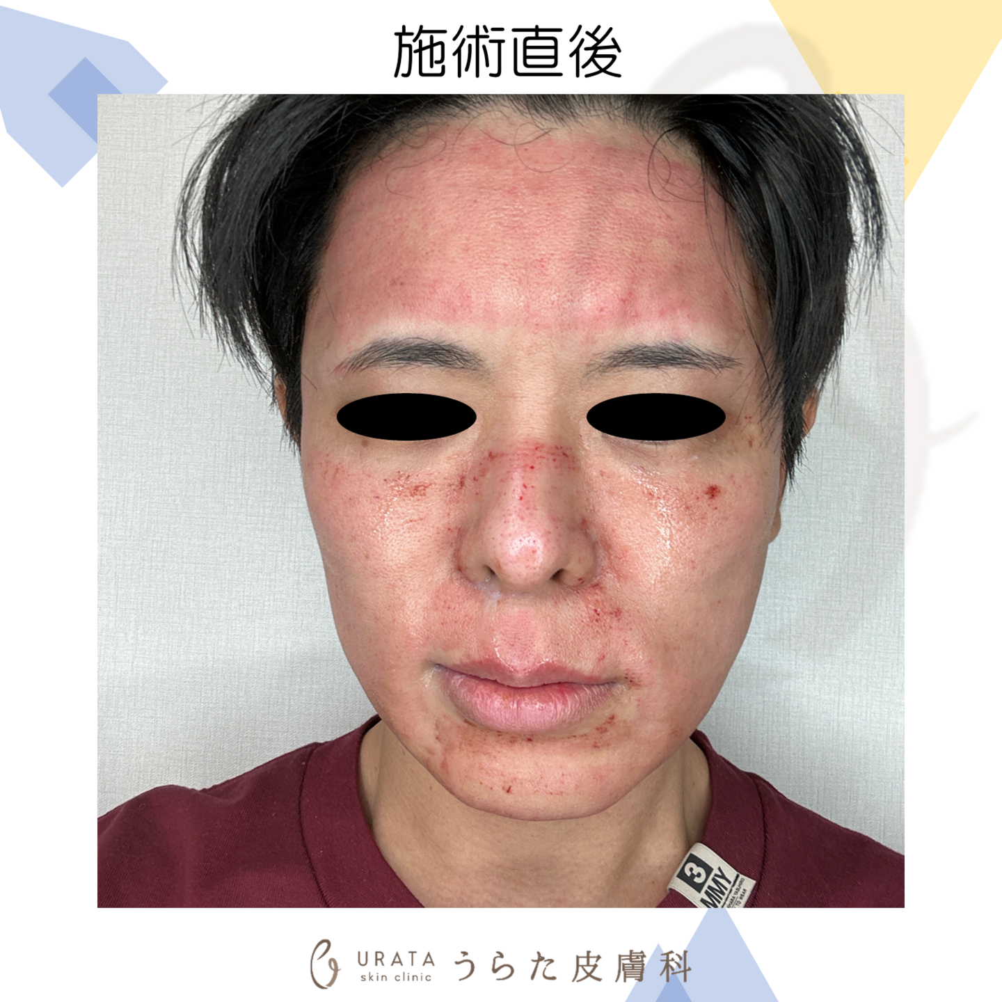 ポテンツァのダウンタイム施術直後 成人アトピー男性