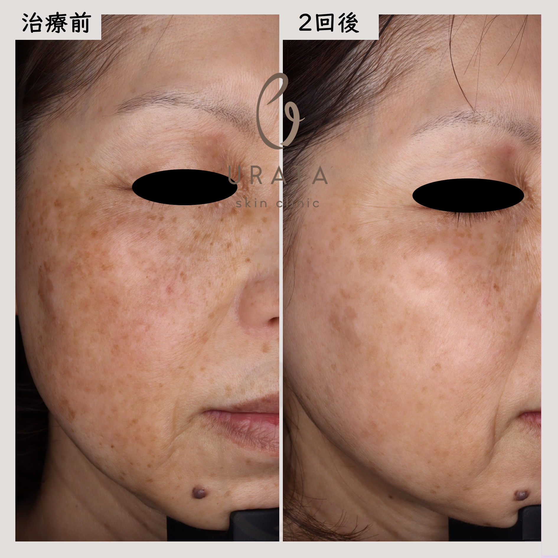 tria 美容 家庭用シミ取りレーザー 肝斑 ニキビ跡 色素沈着 毛穴開き 美白 ピコフラクショナルによるシミ取り・ニキビ跡・毛穴治療なら