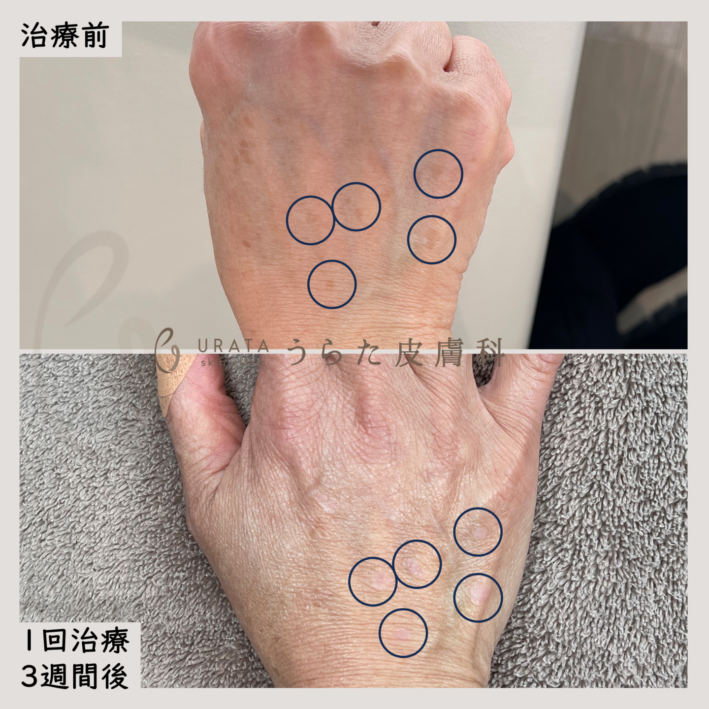 手のシミのピコレーザー治療1