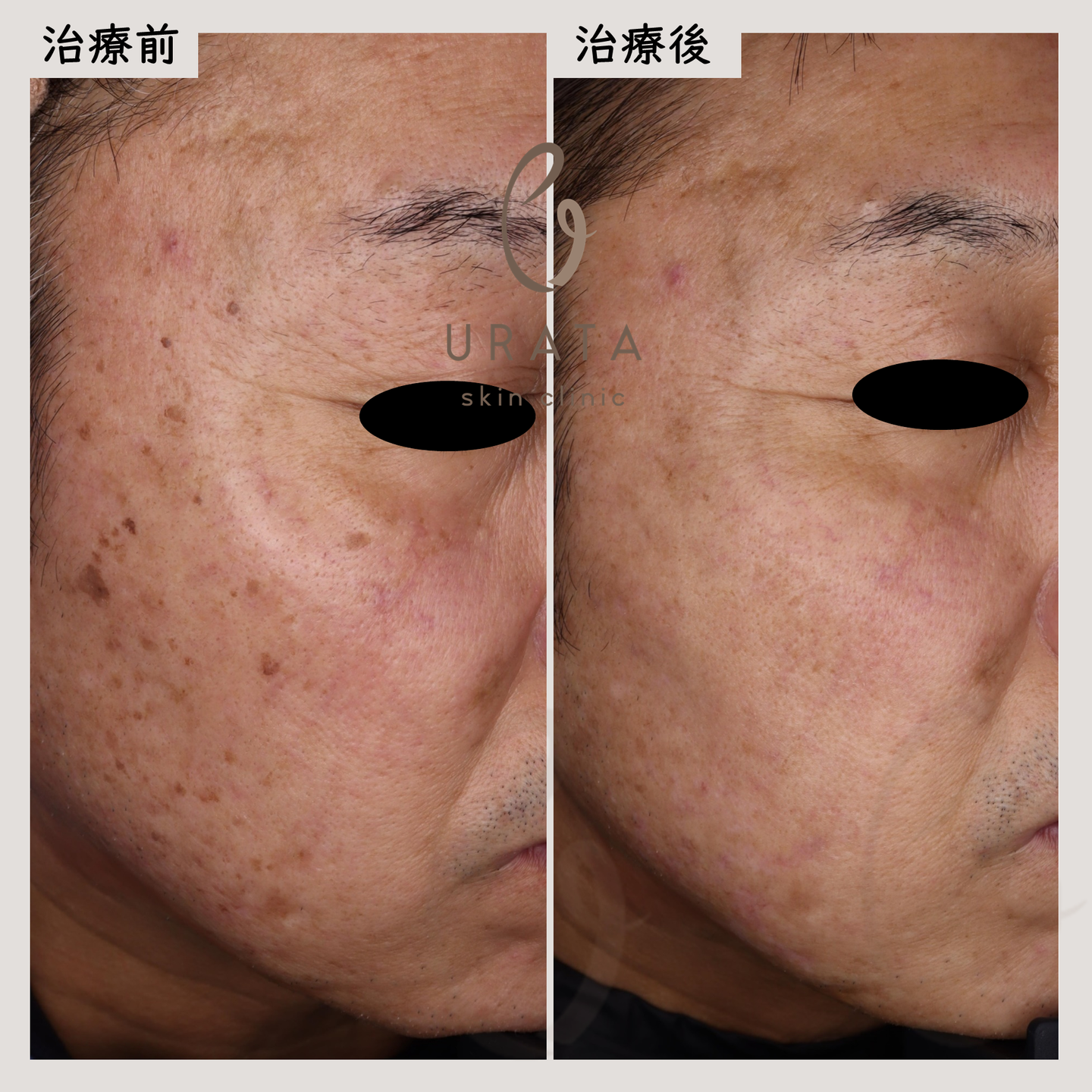 脂漏性角化症のCO2レーザー治療3