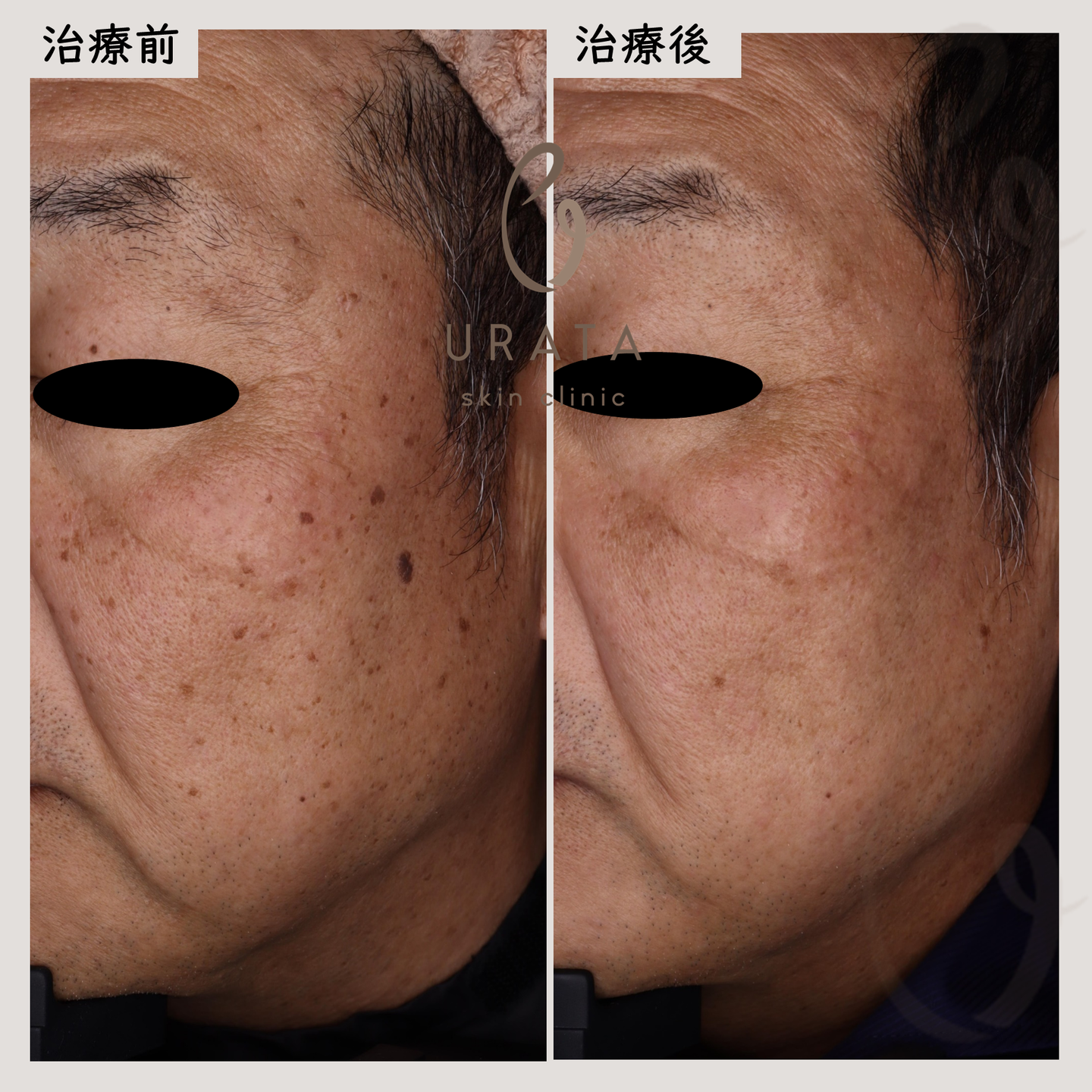 脂漏性角化症のCO2レーザー治療2