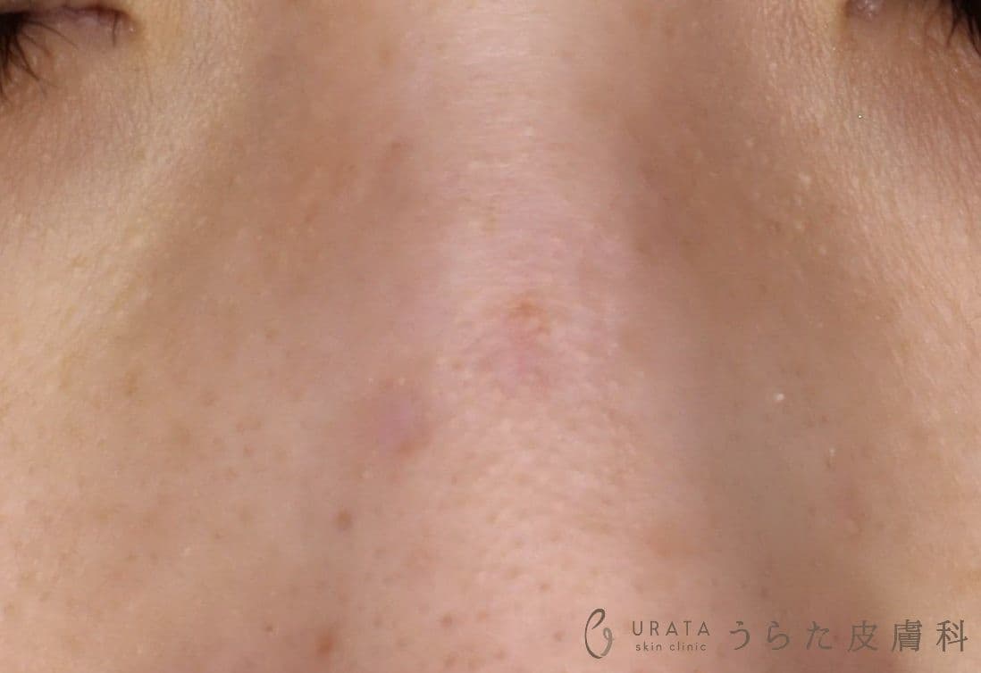 ホクロくり抜き法 術後6カ月