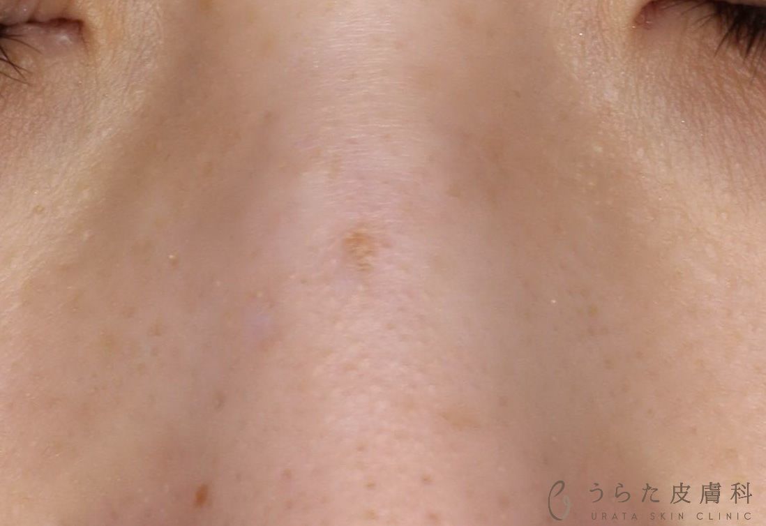 ホクロくり抜き法 術後1年