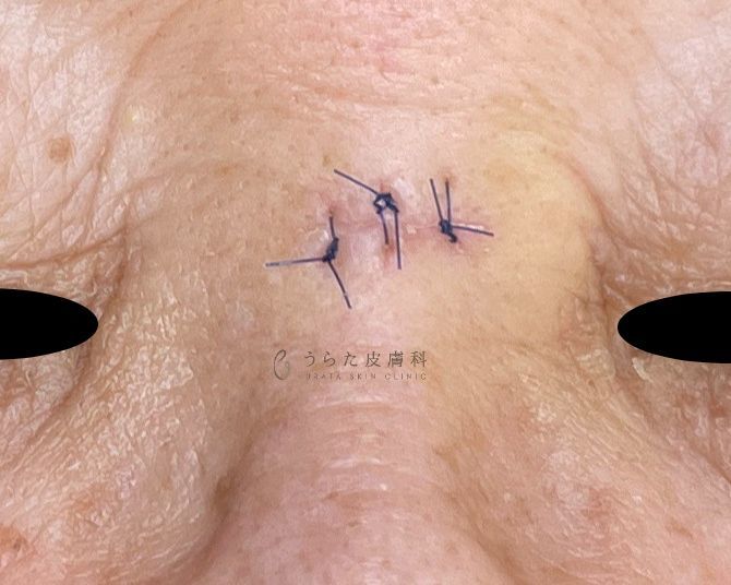 眉間のほくろ手術1週間後の抜糸前
