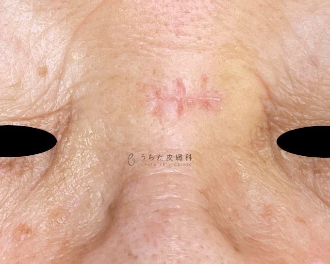 眉間のほくろ手術1週間後の抜糸直後