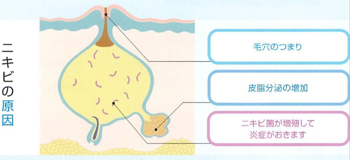 ニキビの原因