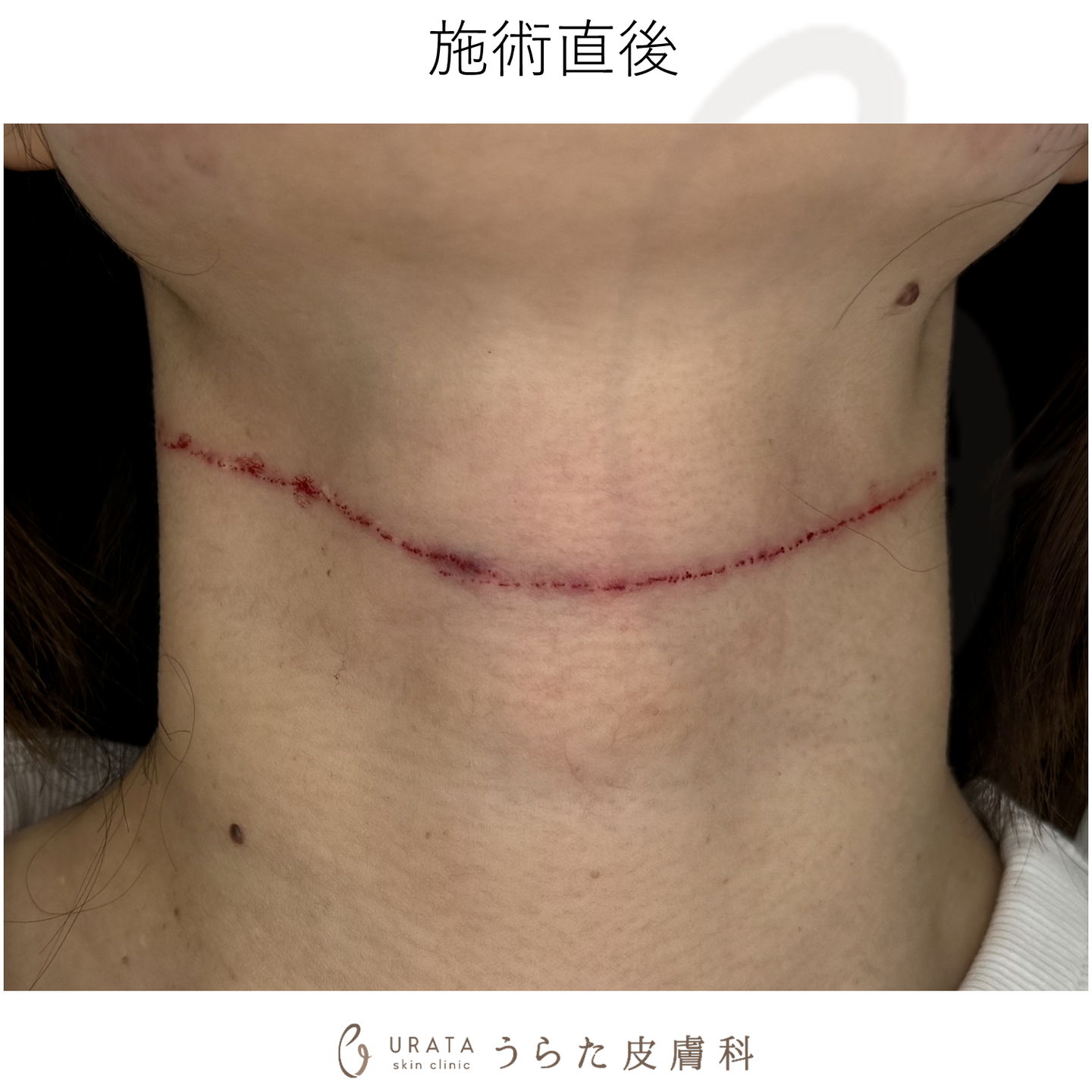 キュアジェットのしわ治療のダウンタイム 施術直後