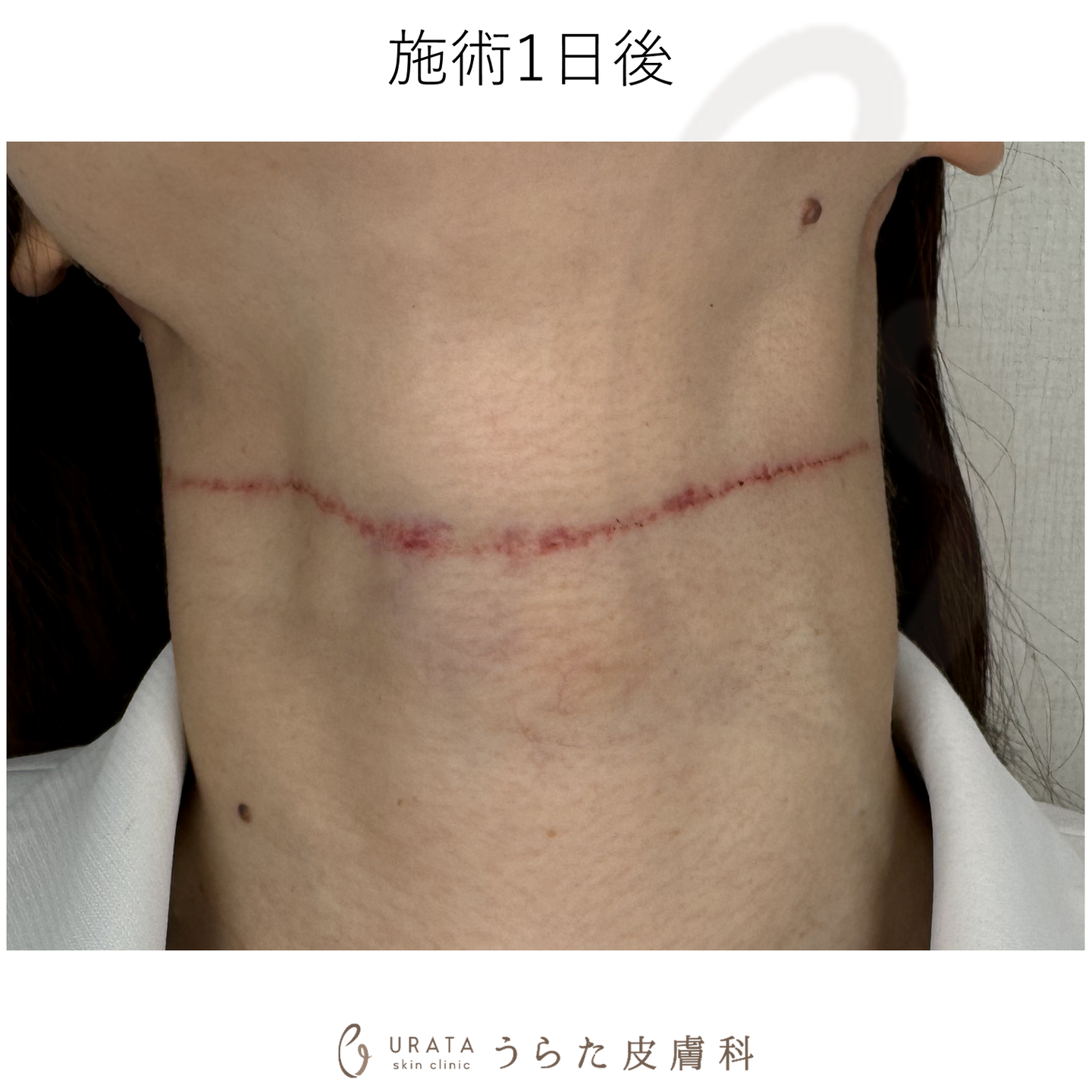 キュアジェットのしわ治療のダウンタイム 施術翌日