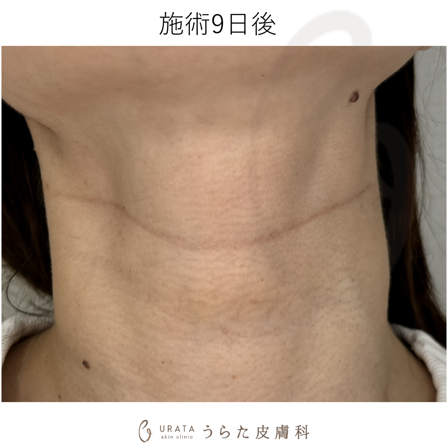 キュアジェットのしわ治療のダウンタイム 施術9日後