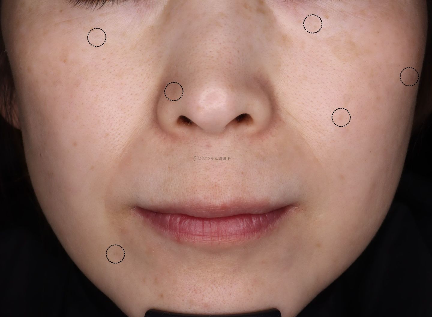 ホクロ手術10カ月後