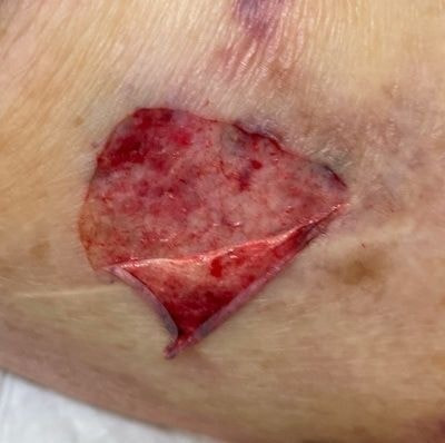 皮膚がめくれた