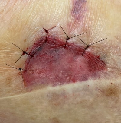 捲れた皮膚を縫い合わせます