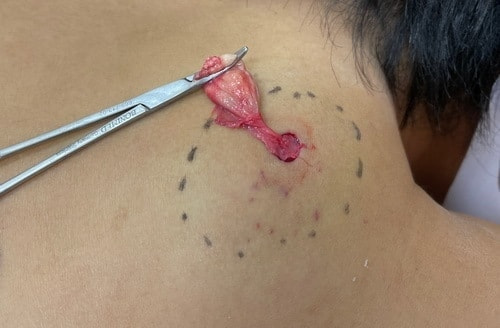 背部粉瘤のくりぬき法で摘出
