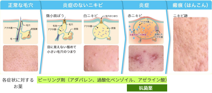 ニキビのステージ解説