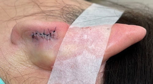 耳裏粉瘤の術後