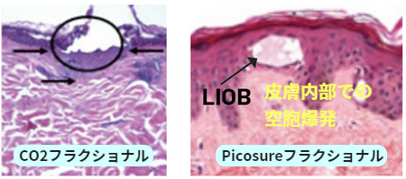 ピコフラクショナルの病理画像
