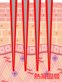 ダーマペンとフラクショナル治療の比較