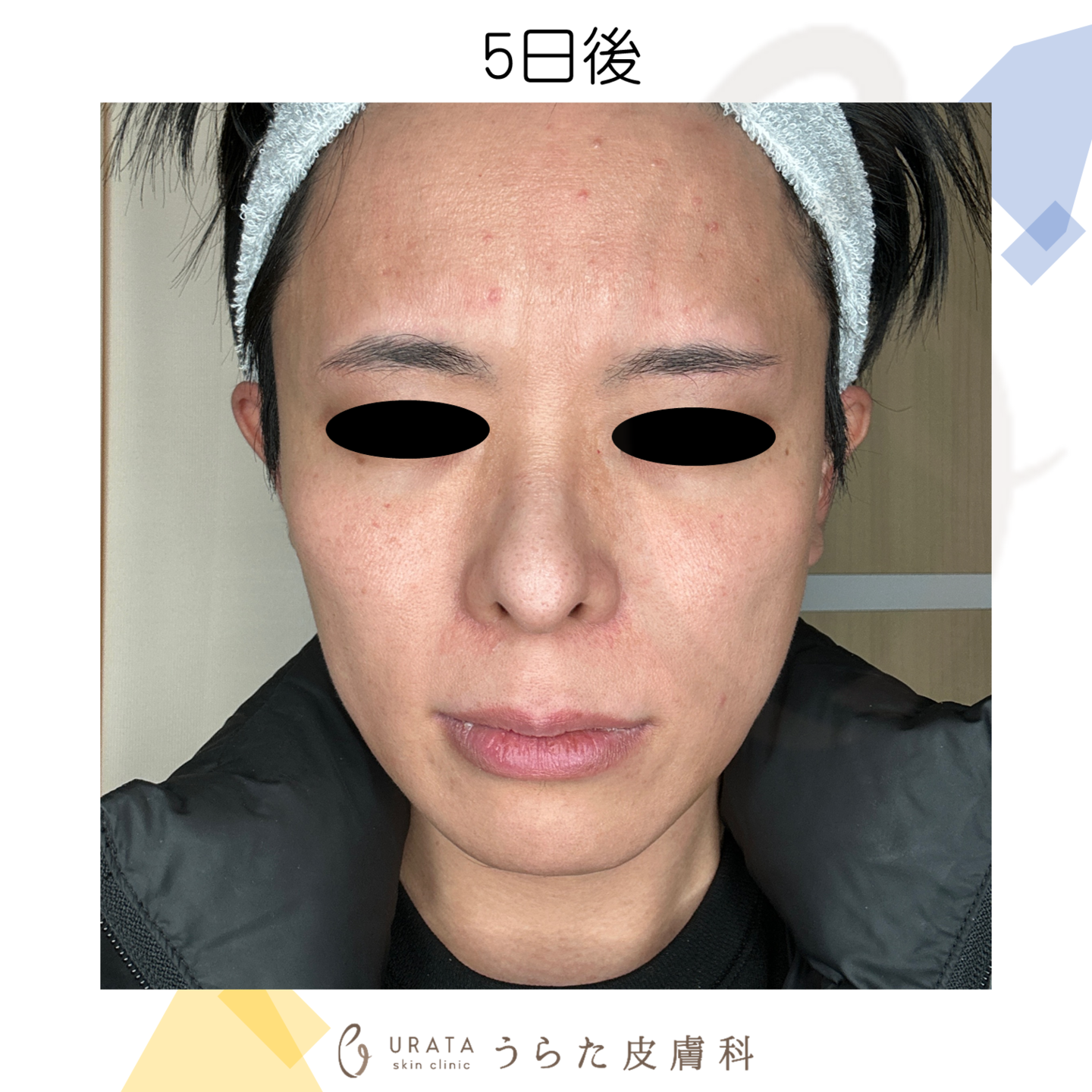 ポテンツァのダウンタイム施術5日後　成人アトピー男性