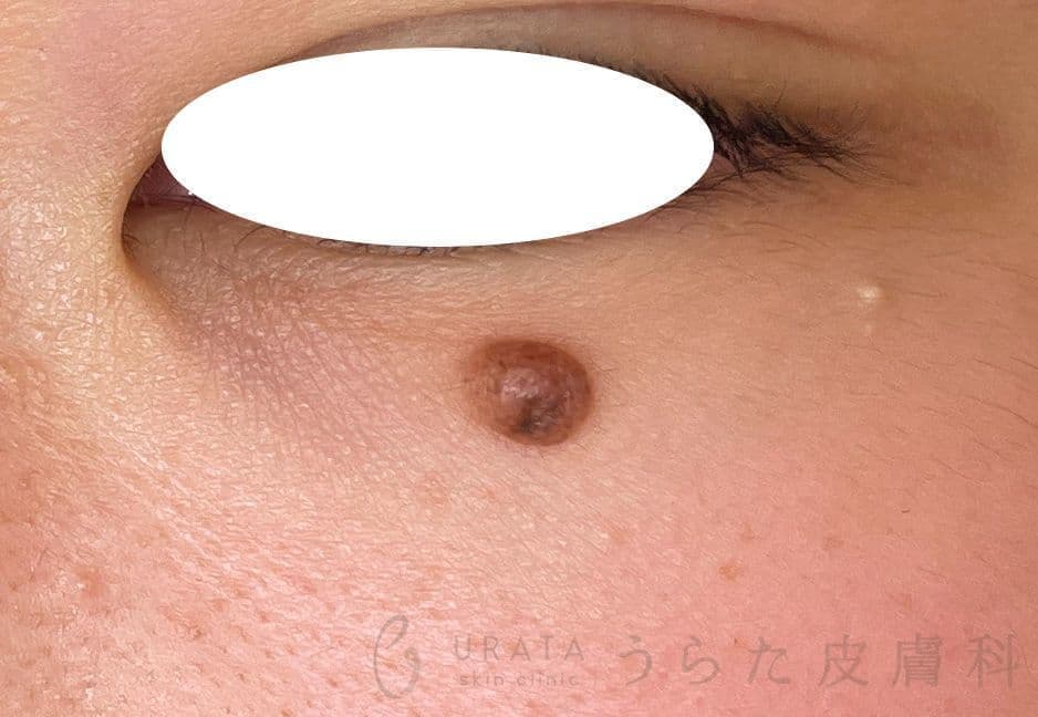 ほくろ手術前
