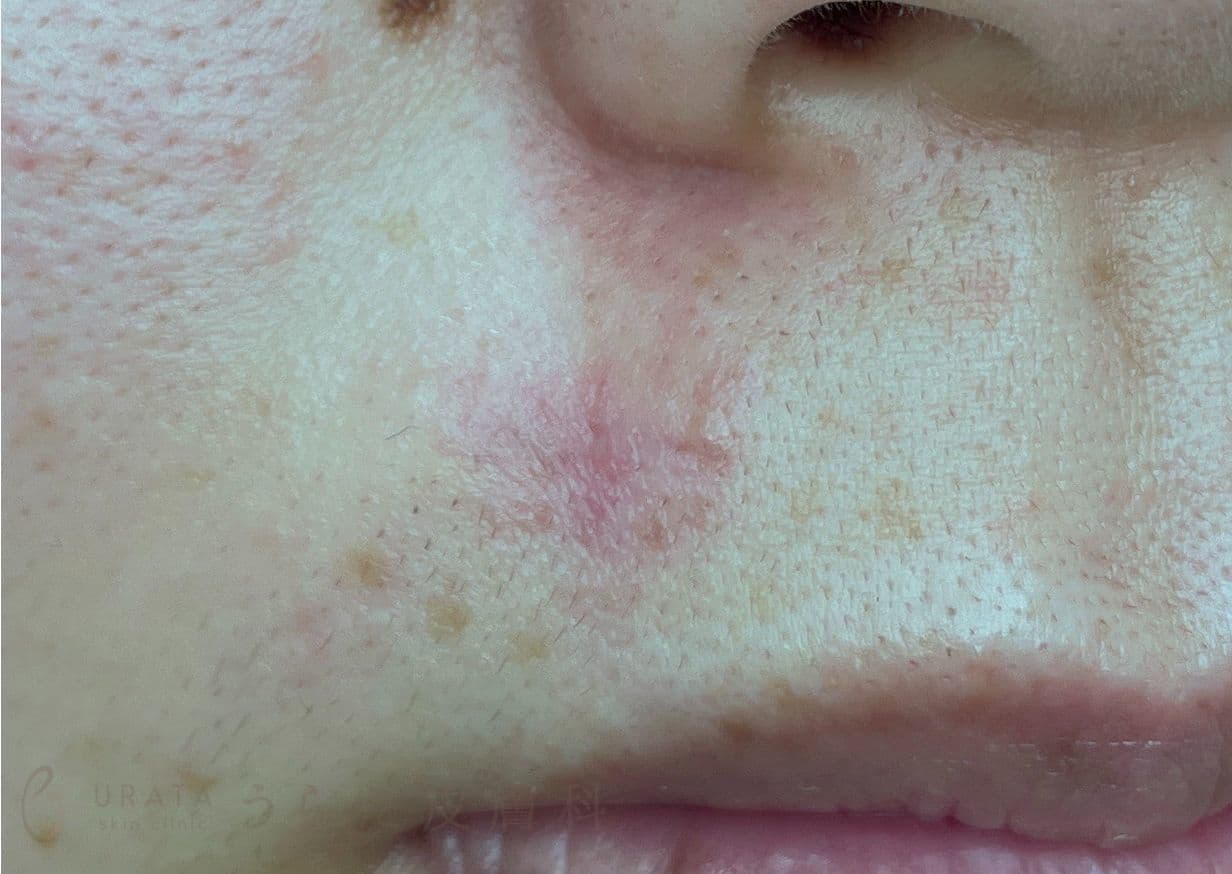 鼻下のほくろ　手術1カ月後