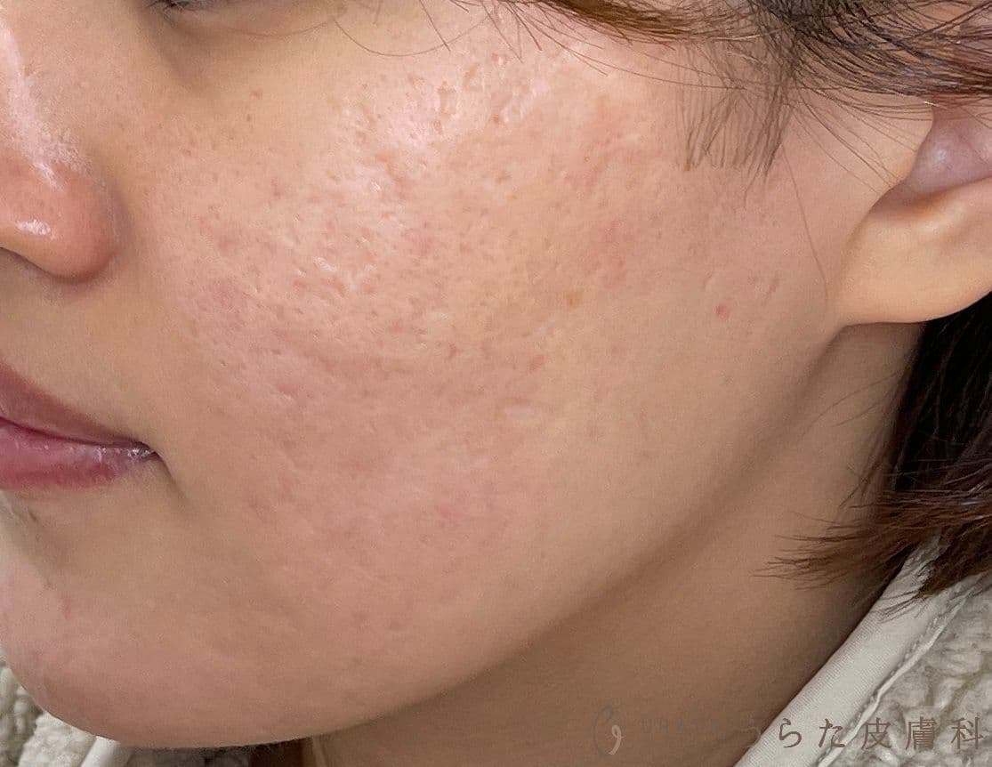 ニキビのホルモン治療　治療後