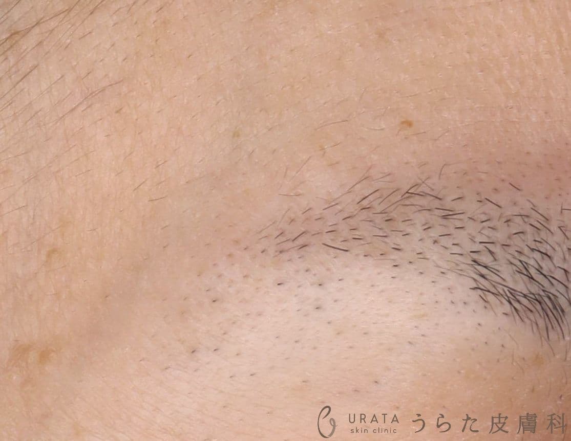 眉部のほくろ　術後８カ月