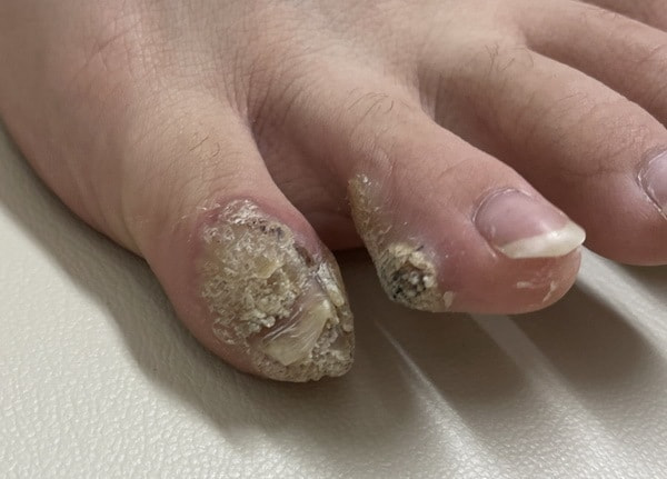 トリクロ治療前