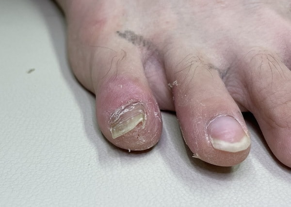 トリクロ２カ月後