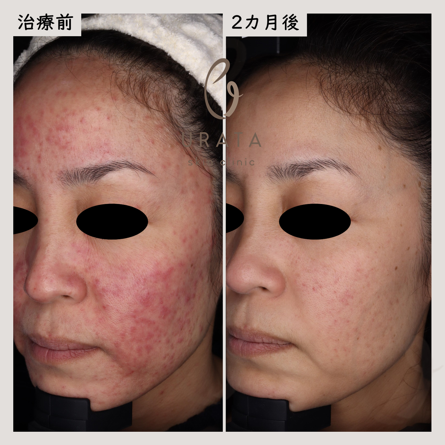 Vビームの酒さ治療１