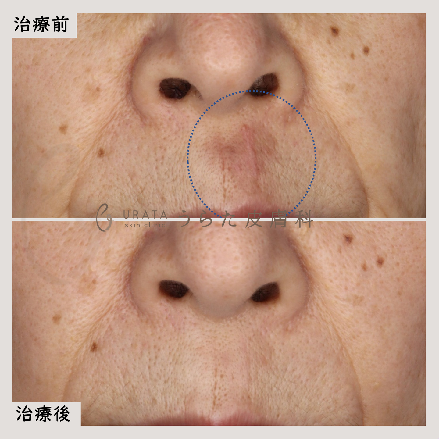 Vビームの赤いキズ跡治療