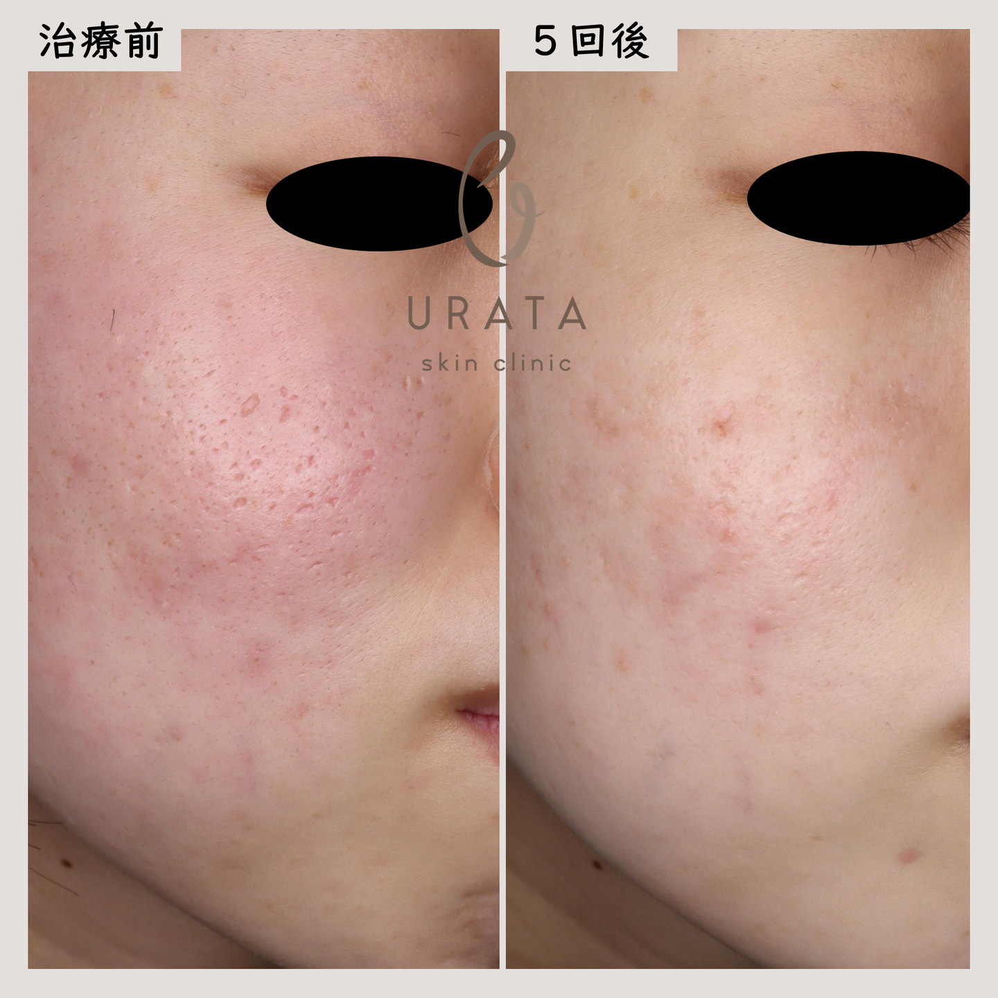 ニキビ跡のCO2フラクショナルレーザー治療１