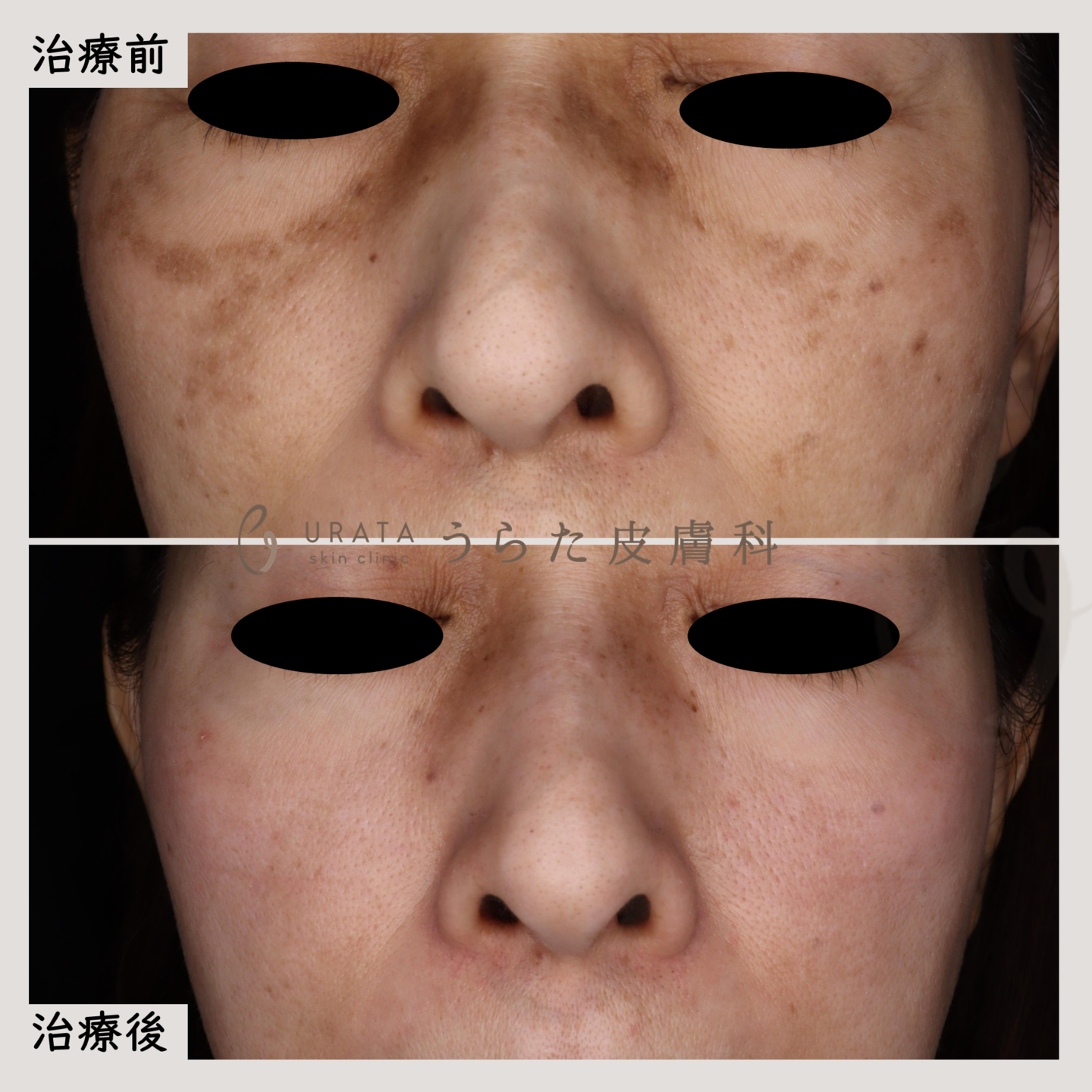 肝斑の塗り薬治療