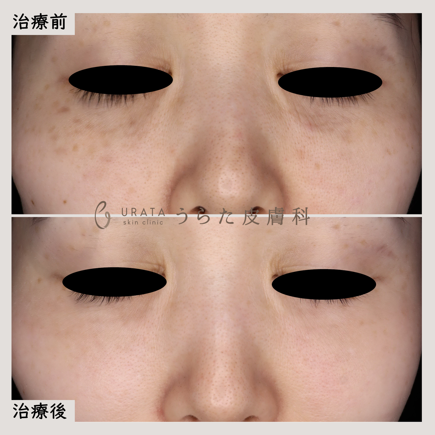 ADMのピコレーザー治療１